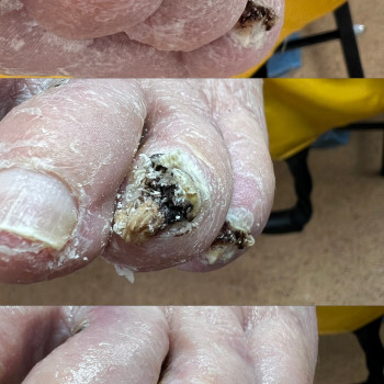 Грибкові нігті

 
 
 