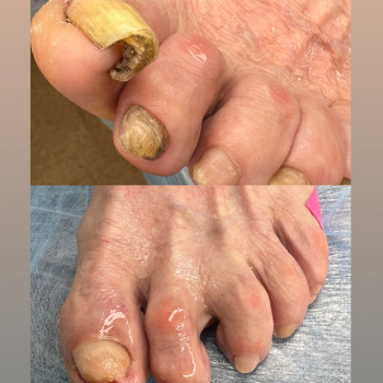 Грибкові нігті

 
 
 