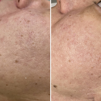 Лазерная шлифовка лица и тела
                    Косметологічний центр Beautymed Clinic Запоріжжя