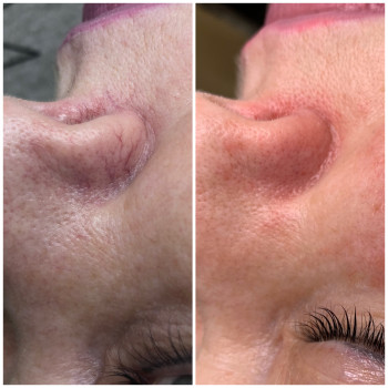 IPL Lumecca лікування судин
                    Косметологический центр Beautymed Clinic Запорожье