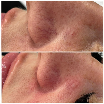 IPL Lumecca лікування судин
                    Косметологический центр Beautymed Clinic Запорожье