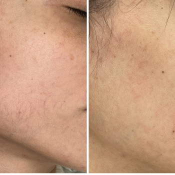 IPL Lumecca лікування судин
                    Косметологический центр Beautymed Clinic Запорожье