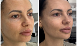 Векторний ліфтинг Radiesse Косметологический центр Beautymed Clinic Запорожье