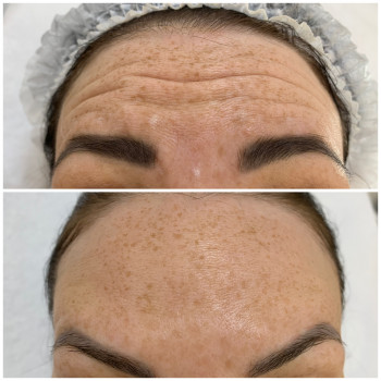 Ботулінотерапія
                    Косметологічний центр Beautymed Clinic Запоріжжя