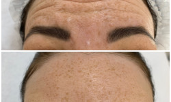 Ботулінотерапія Косметологічний центр Beautymed Clinic Запоріжжя