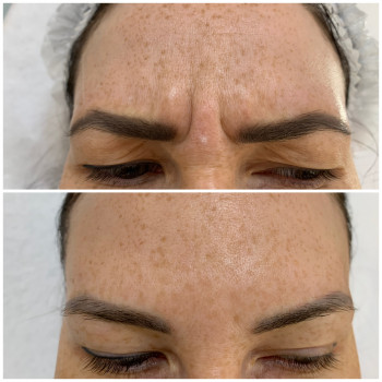 Ботулінотерапія
                    Косметологічний центр Beautymed Clinic Запоріжжя