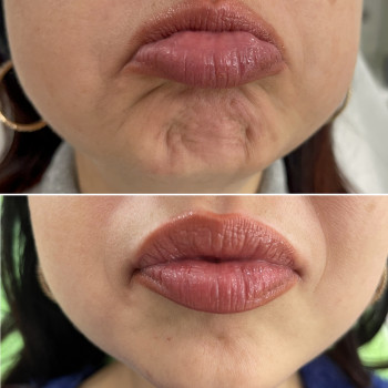 Ботулінотерапія
                    Косметологічний центр Beautymed Clinic Запоріжжя