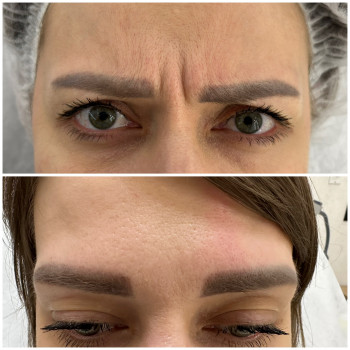 Ботулінотерапія
                    Косметологічний центр Beautymed Clinic Запоріжжя