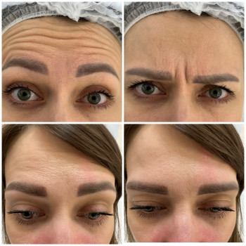 Ботулінотерапія
                    Косметологічний центр Beautymed Clinic Запоріжжя