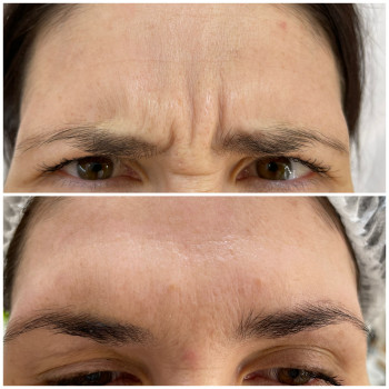 Ботулінотерапія
                    Косметологічний центр Beautymed Clinic Запоріжжя