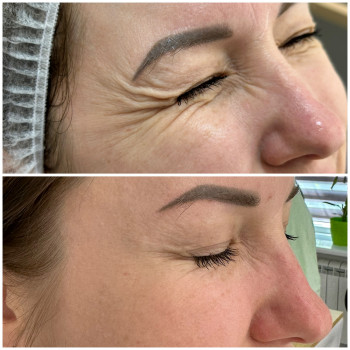 Ботулінотерапія
                    Косметологічний центр Beautymed Clinic Запоріжжя