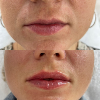 Контурна пластика губ
                    Косметологічний центр Beautymed Clinic Запоріжжя