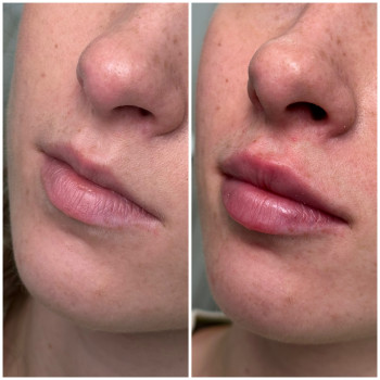 Контурна пластика губ
                    Косметологічний центр Beautymed Clinic Запоріжжя