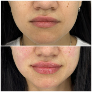Контурна пластика губ
                    Косметологічний центр Beautymed Clinic Запоріжжя