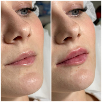 Контурна пластика губ
                    Косметологічний центр Beautymed Clinic Запоріжжя