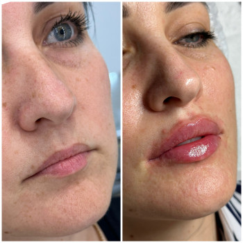 Контурна пластика губ
                    Косметологічний центр Beautymed Clinic Запоріжжя