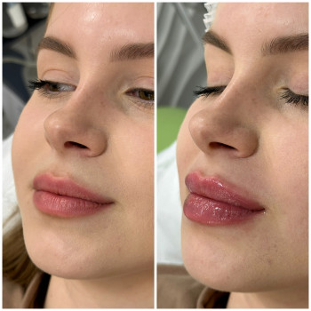 Контурна пластика губ
                    Косметологічний центр Beautymed Clinic Запоріжжя