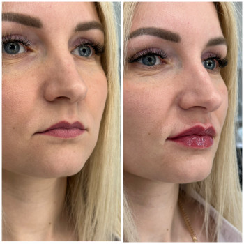 Контурна пластика губ
                    Косметологічний центр Beautymed Clinic Запоріжжя