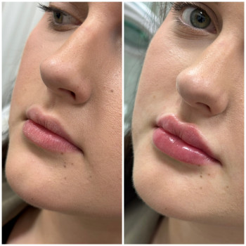 Контурна пластика губ
                    Косметологічний центр Beautymed Clinic Запоріжжя