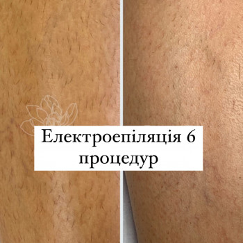 Електроепіляція,видалення волосся назавжди