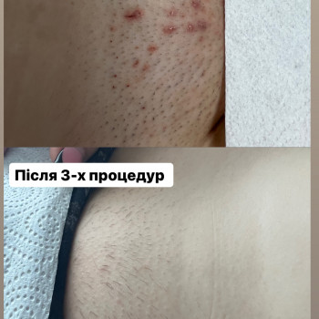 Дівчина підліток мала врослє волосся і роздратування,не голилась після 3-ї процедури 2.5 місяця