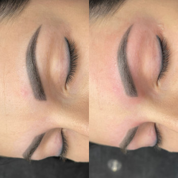 Удаление татуажа