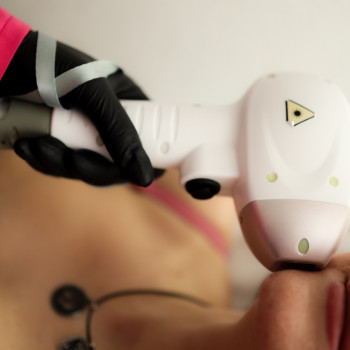 Лазерна епіляція обличчя від 200 грн 
     