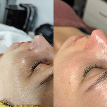 Чистка обличчя
                    Косметолог Маргарита Черкассы