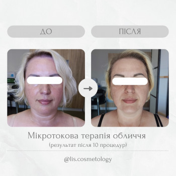 Мікрострумова терапія, 10 процедур, 1 раз в день