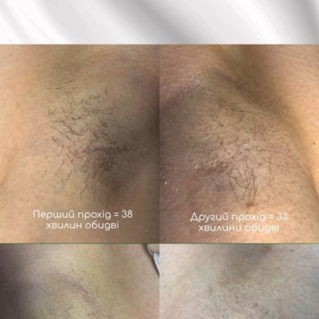 Електроепіляція
                    Майстер депіляції Єлизавета Київ