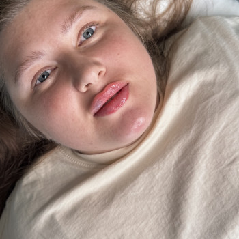 Збільшення губ
 