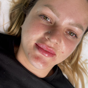 Збільшення губ