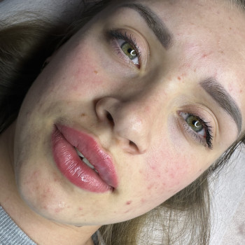 Збільшення губ