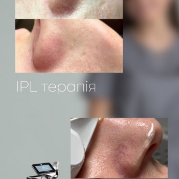 IPL терапія
                    Дерматолог косметолог Марта Львів