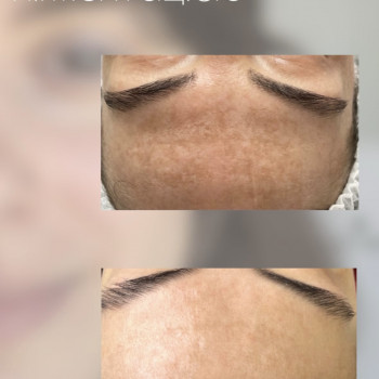 IPL терапія
                    Дерматолог косметолог Марта Львів