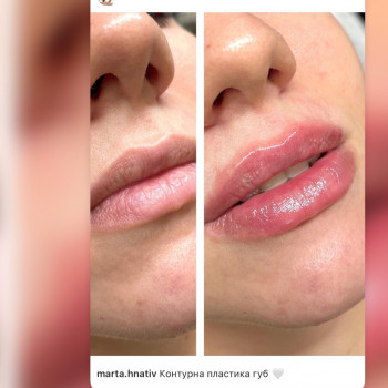 Контурна пластика губ 
Препарат вибору Juvederm