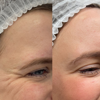 Botox фото перед процедурою та 14 днів після