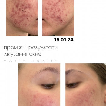 Лікування акне 
Це досить довгий період , але якщо набратись терпіння -все цілком реально 🤍