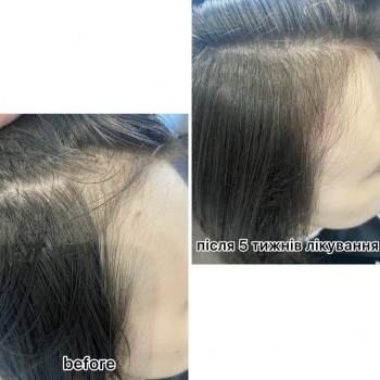 Безінєкційна мезотерапія волосся
                    Салон красоты Центр Красоты и Здоровья Волос Киев