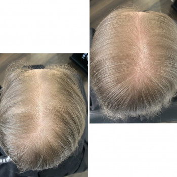 Безінєкційна мезотерапія волосся
                    Салон красоты Центр Красоты и Здоровья Волос Киев