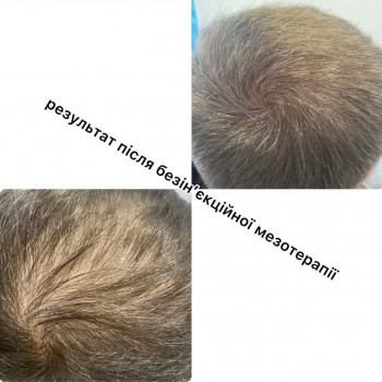 Безінєкційна мезотерапія волосся
                    Салон красоты Центр Красоты и Здоровья Волос Киев