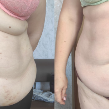 Результат після 6 процедур
-10 см в об'ємі