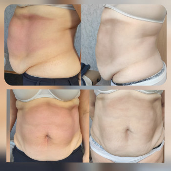 Результат після 3 сеансів