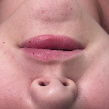 Збільшення губ