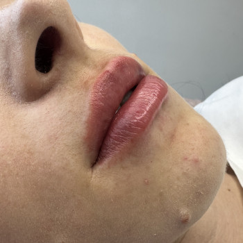 Збільшення губ