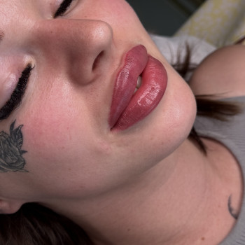 Збільшення губ