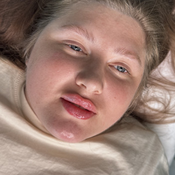 Збільшення губ