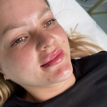 Збільшення губ