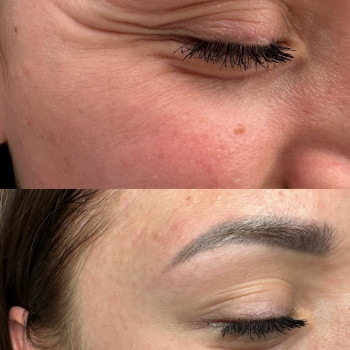 Ботулінотерапія очі