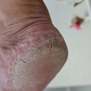 Фото з портфоліо фахівця Руслана Гончарова (подолог, Миколаїв)